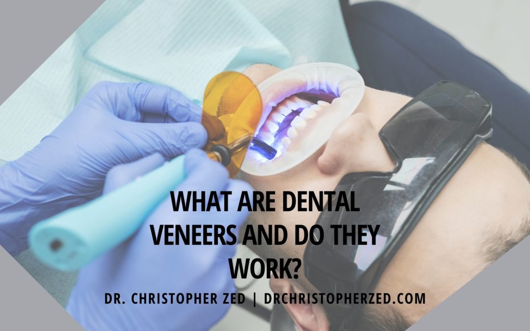 What Are Dental Veneers And Do They Work
